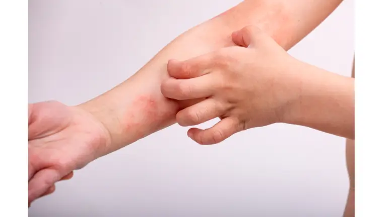 ¿Qué Deben Saber los Padres sobre la Dermatitis Atópica en Niños?