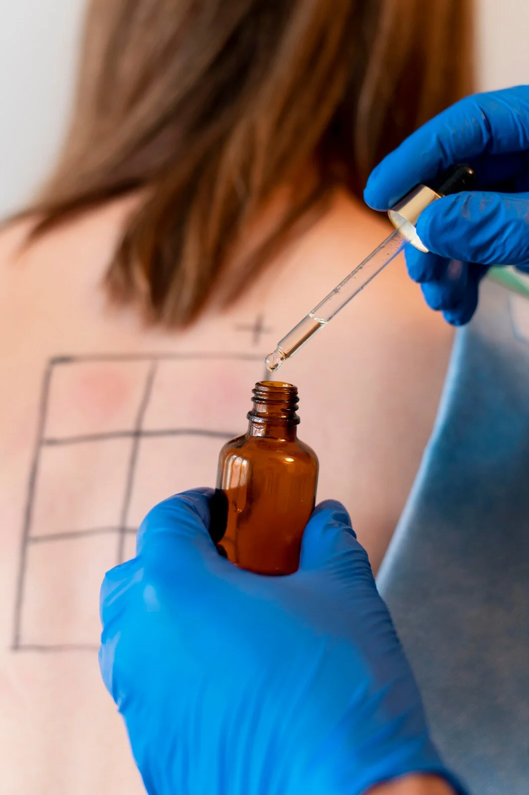 Tratamiento de Alergias